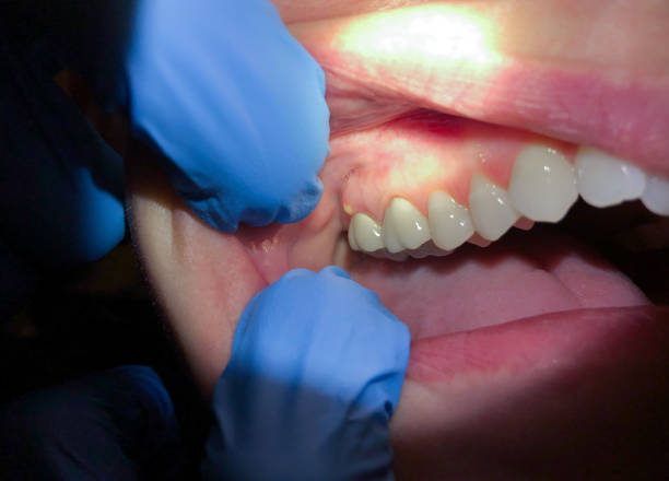 Best Tooth Infection Emergency Dentist  in Frederickson, WA